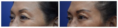 Eyelid Surgery Before & After Gallery - Patient 4631083 - Image 2