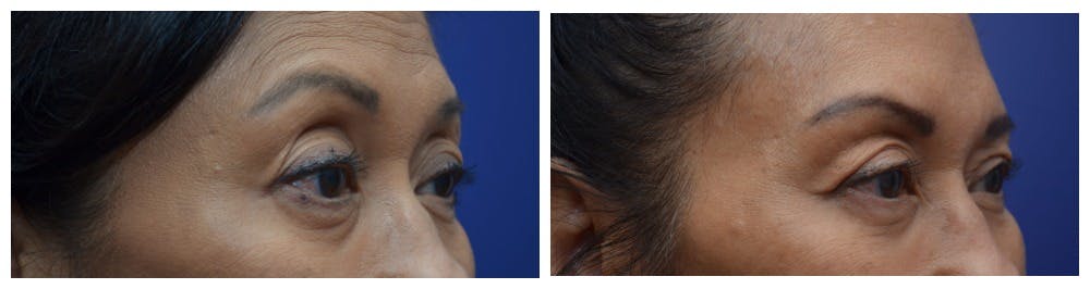 Upper Eyelid Ptosis Repair Before & After Gallery - Patient 4588779 - Image 2