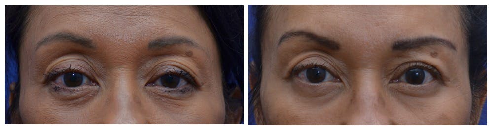 Upper Eyelid Ptosis Repair Before & After Gallery - Patient 4588779 - Image 1