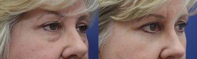Eyelid Surgery Before & After Gallery - Patient 4588569 - Image 2