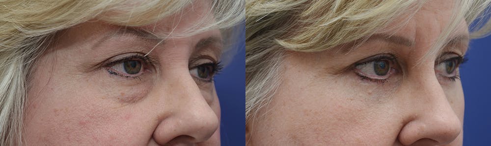 Eyelid Surgery Before & After Gallery - Patient 4588569 - Image 2