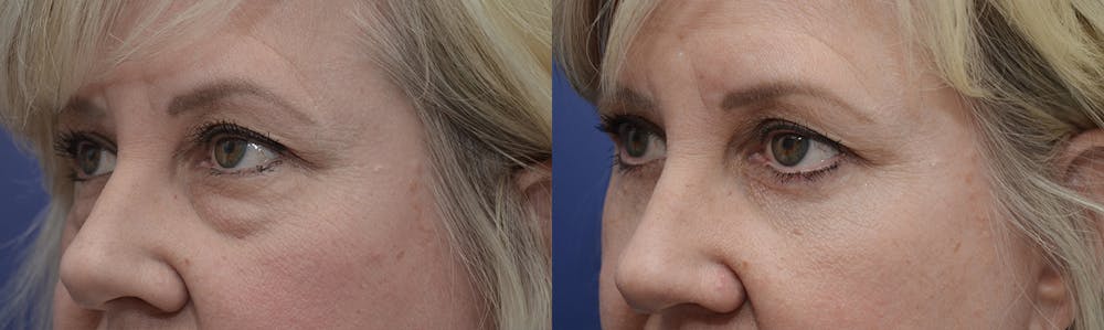 Eyelid Surgery Before & After Gallery - Patient 4588569 - Image 3