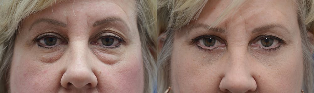 Eyelid Surgery Before & After Gallery - Patient 4588569 - Image 1
