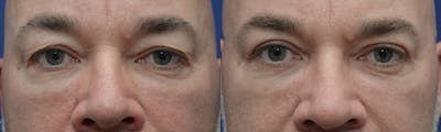 Eyelid Surgery Before & After Gallery - Patient 4588586 - Image 1