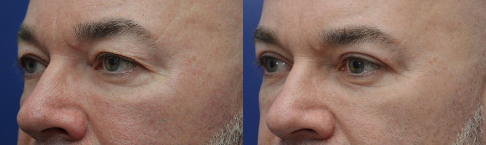 Eyelid Surgery Before & After Gallery - Patient 4588586 - Image 2