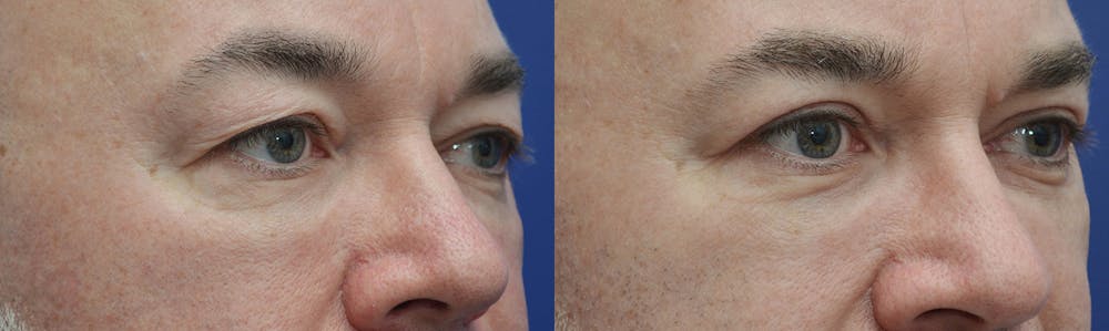 Eyelid Surgery Before & After Gallery - Patient 4588586 - Image 3