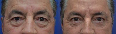 Brow Lift (Forehead Lift) Before & After Gallery - Patient 4588632 - Image 1