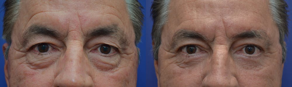 Brow Lift (Forehead Lift) Gallery - Patient 4588632 - Image 1