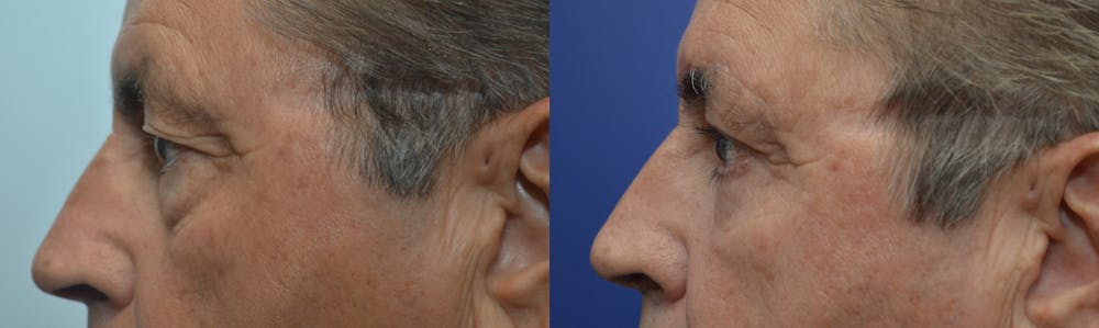 Eyelid Surgery Before & After Gallery - Patient 4588587 - Image 3