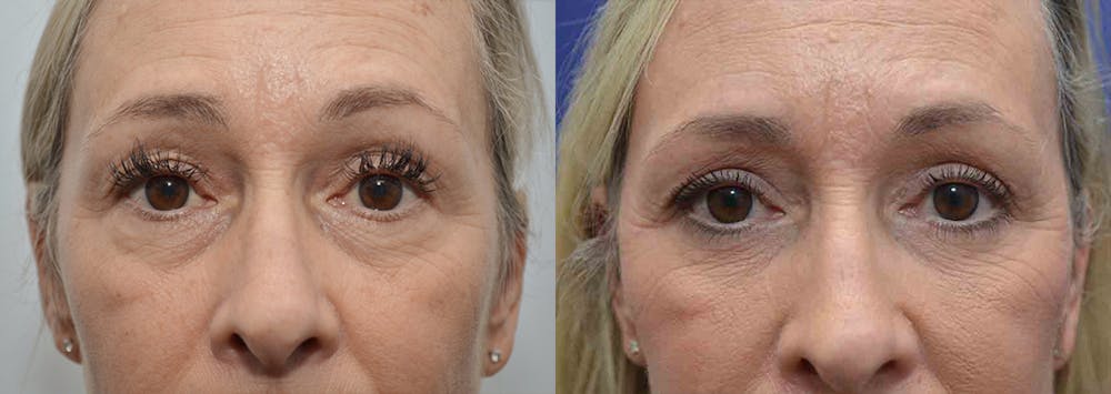 Eyelid Surgery Before & After Gallery - Patient 4588588 - Image 1