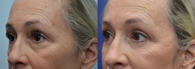 Eyelid Surgery Before & After Gallery - Patient 4588588 - Image 2