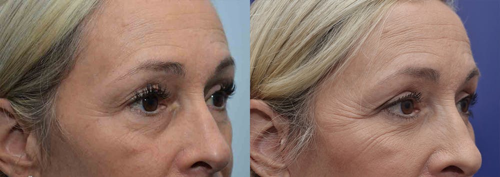 Eyelid Surgery Before & After Gallery - Patient 4588588 - Image 3