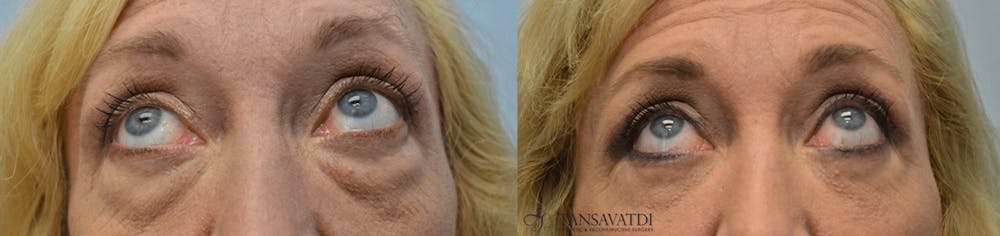 Eyelid Surgery Before & After Gallery - Patient 4588600 - Image 1