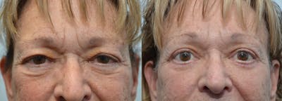 Brow Lift (Forehead Lift) Before & After Gallery - Patient 4588640 - Image 1
