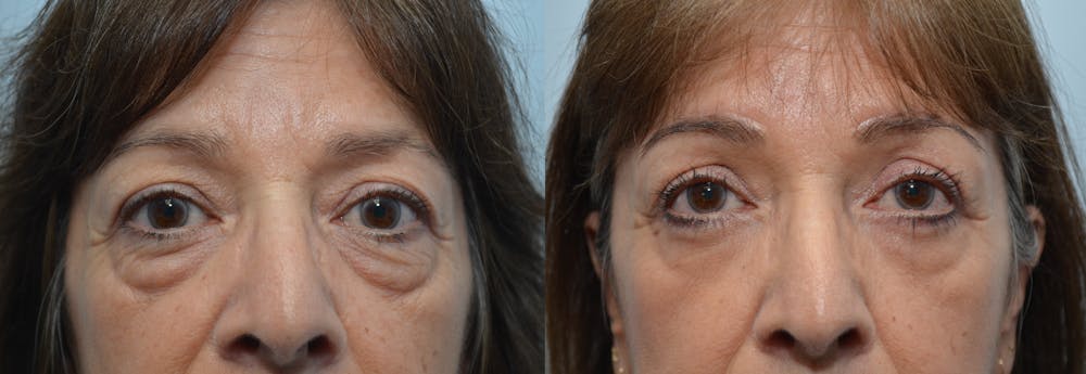 Brow Lift (Forehead Lift) Before & After Gallery - Patient 4588642 - Image 1