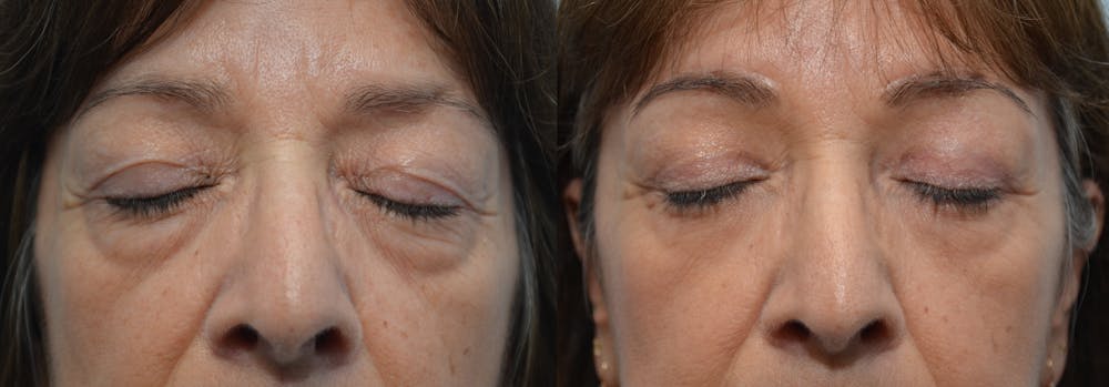 Brow Lift (Forehead Lift) Before & After Gallery - Patient 4588642 - Image 2