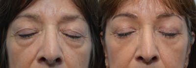 Brow Lift (Forehead Lift) Before & After Gallery - Patient 4588642 - Image 2