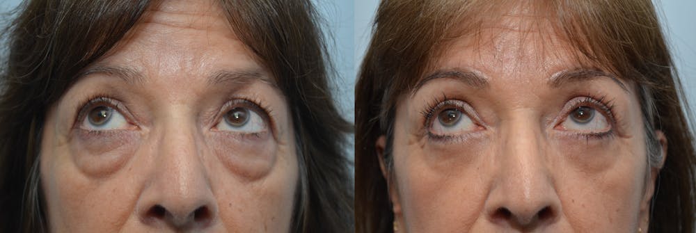 Brow Lift (Forehead Lift) Before & After Gallery - Patient 4588642 - Image 3