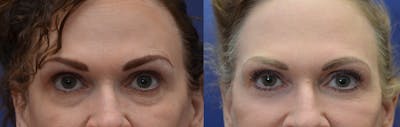 Eyelid Surgery Before & After Gallery - Patient 4588607 - Image 1