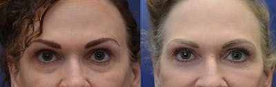Eyelid Surgery Before & After Gallery - Patient 4588607 - Image 1