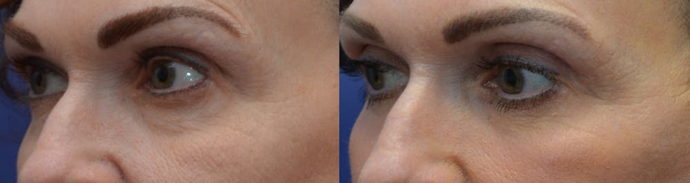 Eyelid Surgery Before & After Gallery - Patient 4588607 - Image 2