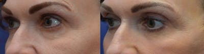 Eyelid Surgery Before & After Gallery - Patient 4588607 - Image 2