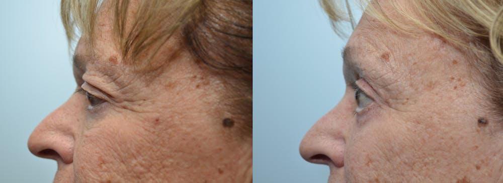 Brow Lift (Forehead Lift) Before & After Gallery - Patient 4588640 - Image 3