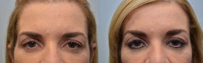 Botox / Xeomin Before & After Gallery - Patient 4588775 - Image 1