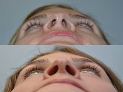 Rhinoplasty (Nose Reshaping) Before & After Gallery - Patient 4588552 - Image 4