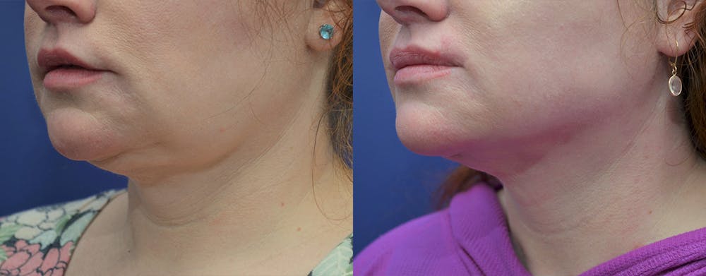 Facetite™: Non-Surgical Facelift Before & After Gallery - Patient 4701919 - Image 1