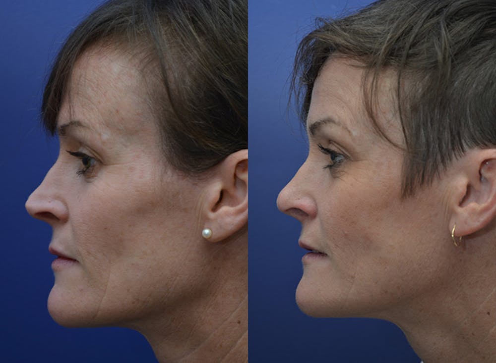 Revision Rhinoplasty Before & After Gallery - Patient 5063084 - Image 5