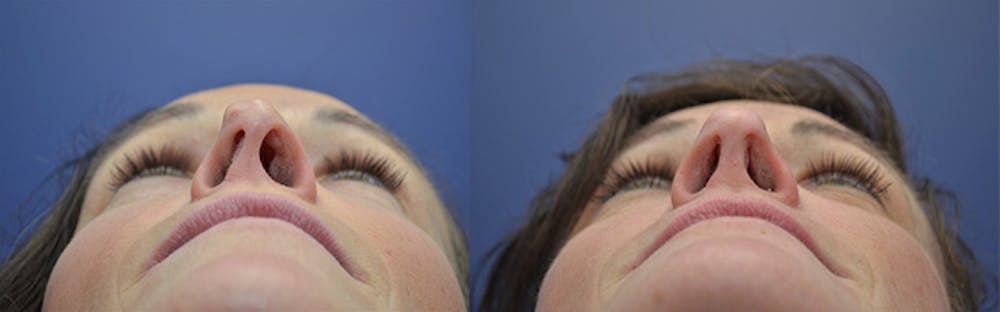 Revision Rhinoplasty Before & After Gallery - Patient 5063084 - Image 6