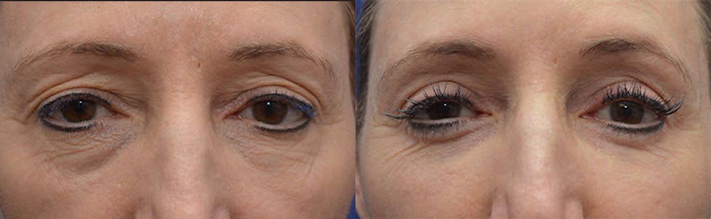 Eyelid Surgery Before & After Gallery - Patient 4588563 - Image 1