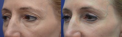 Eyelid Surgery Before & After Gallery - Patient 4588563 - Image 2
