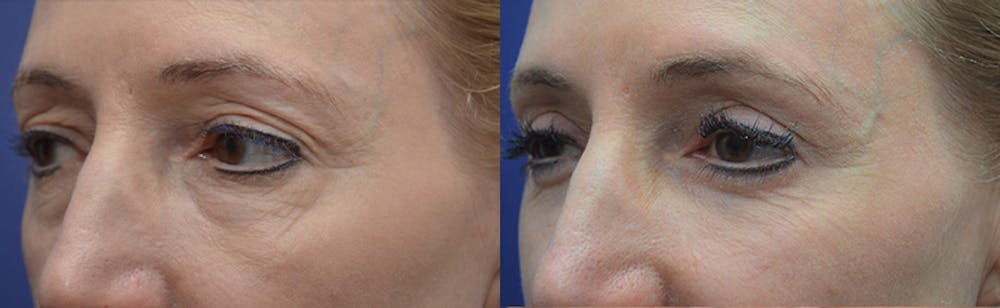 Eyelid Surgery Before & After Gallery - Patient 4588563 - Image 2