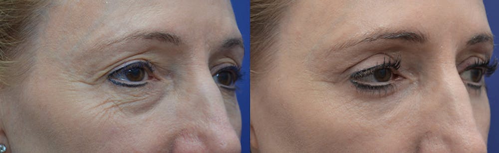 Eyelid Surgery Before & After Gallery - Patient 4588563 - Image 3