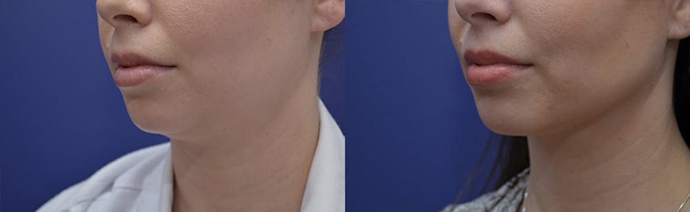 Liposuction Before & After Gallery - Patient 5063151 - Image 2