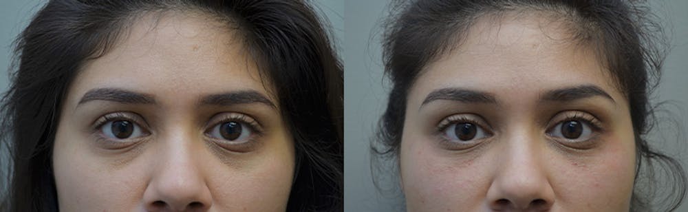 Under Eye Rejuvenation Before & After Gallery - Patient 5063152 - Image 1