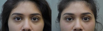 Under Eye Rejuvenation Before & After Gallery - Patient 5063152 - Image 1