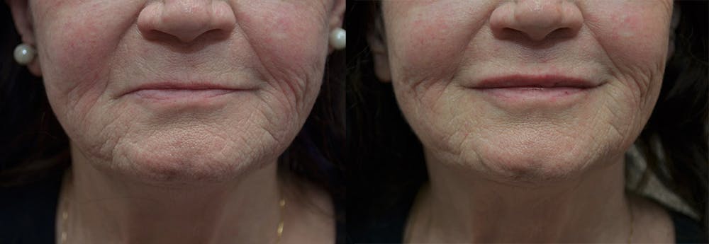 Non-Surgical Soft Tissue Fillers Before & After Gallery - Patient 5724922 - Image 1
