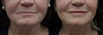 Lip Enhancement Before & After Gallery - Patient 5724924 - Image 1