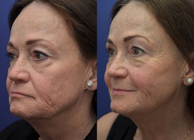 Non-Surgical Soft Tissue Fillers Before & After Gallery - Patient 5724929 - Image 2