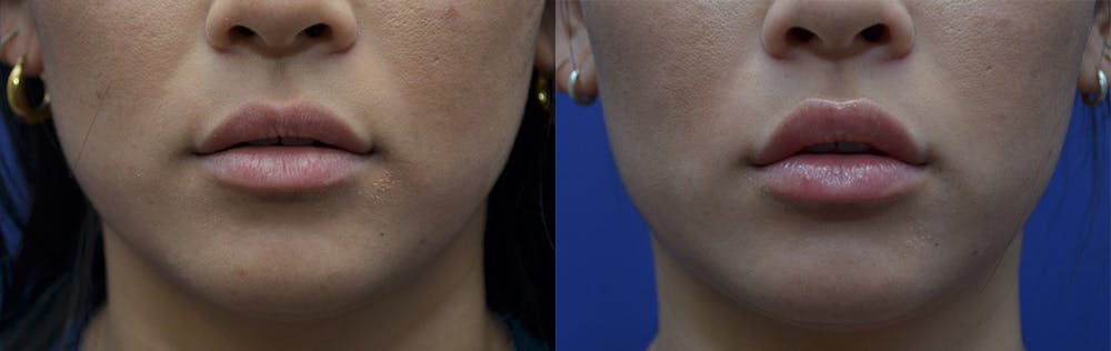 Non-Surgical Soft Tissue Fillers Before & After Gallery - Patient 5724946 - Image 1