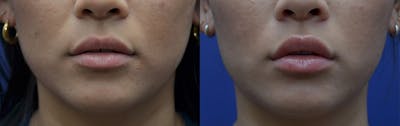 Non-Surgical Soft Tissue Fillers Before & After Gallery - Patient 5724946 - Image 1