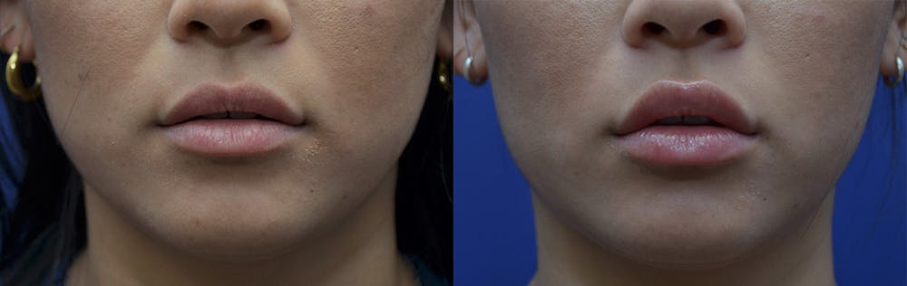 Non-Surgical Soft Tissue Fillers Gallery - Patient 5724946 - Image 1