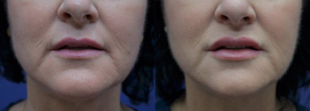 Non-Surgical Soft Tissue Fillers Before & After Gallery - Patient 5724947 - Image 1