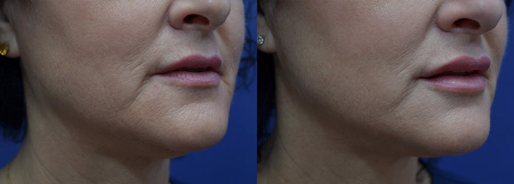 Non-Surgical Soft Tissue Fillers Before & After Gallery - Patient 5724947 - Image 3
