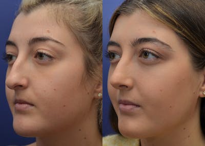 Rhinoplasty (Nose Reshaping) Before & After Gallery - Patient 5788711 - Image 2