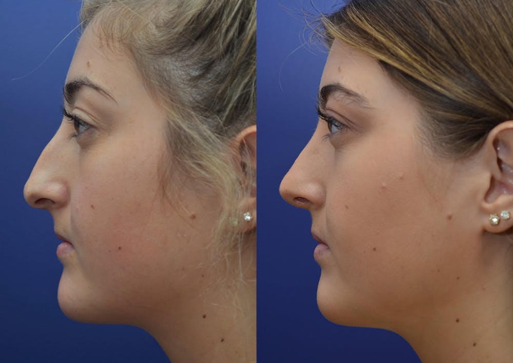Rhinoplasty (Nose Reshaping) Before & After Gallery - Patient 5788711 - Image 3