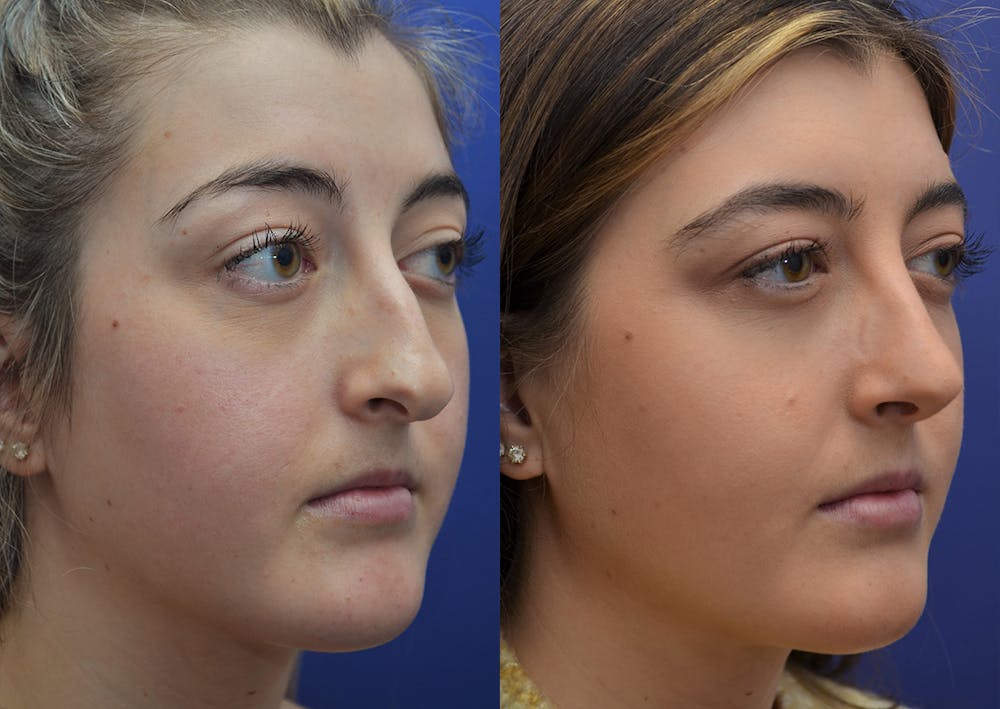 Rhinoplasty (Nose Reshaping) Before & After Gallery - Patient 5788711 - Image 4